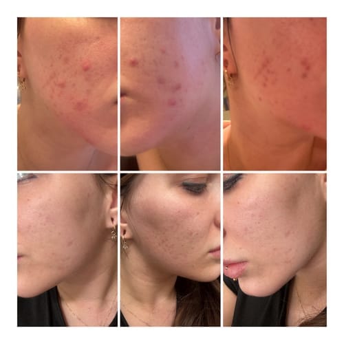 Customer photo review of The Complete Acne Killer System 2.0