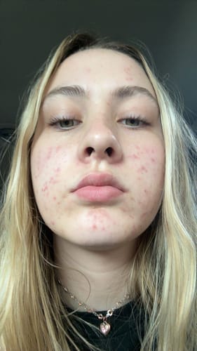 Customer photo review of The Complete Acne Killer System 2.0