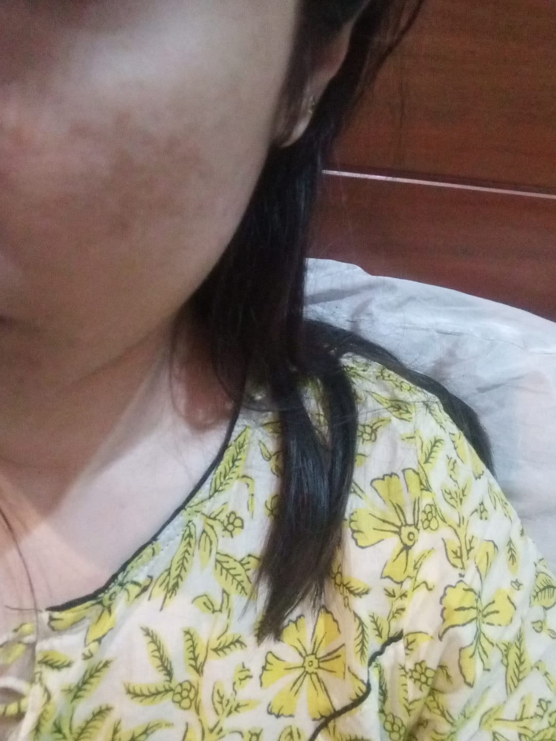 Customer photo review of Tri Melas Cream - Best Melasma Cream