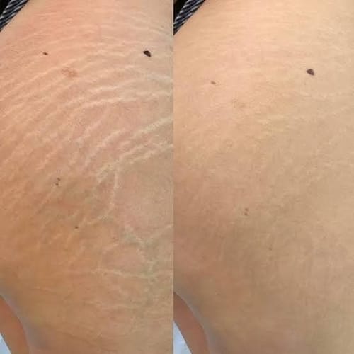 Customer photo review of Crema AntiEstrías🧴🦵 - 200ml EMILY