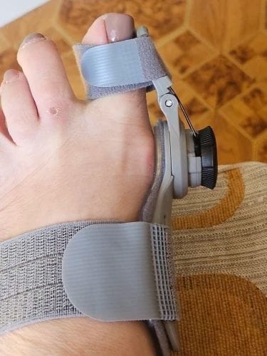 Customer photo review of Bunion corrector | Sameo
