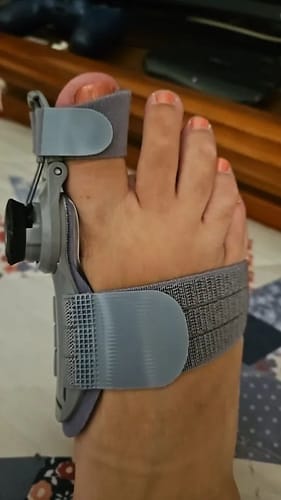 Customer photo review of Bunion corrector | Sameo