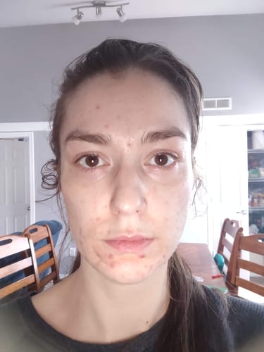 Customer photo review of F-Balm BULK ORDER Pricing (Pack of 10)