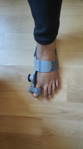 Customer photo review of Bunion corrector | Sameo