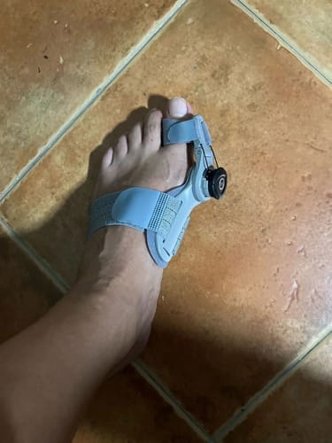 Customer photo review of Bunion corrector | Sameo