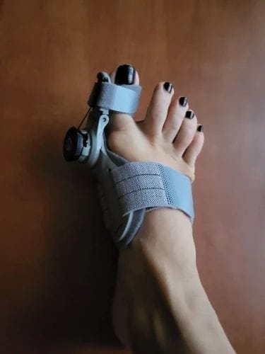 Customer photo review of Bunion corrector | Sameo