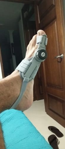 Customer photo review of Bunion corrector | Sameo