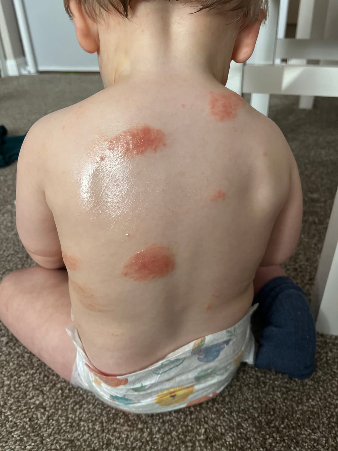 Customer photo review of Bioskin Junior Outbreak Rescue Cream