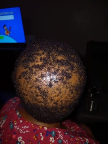 Customer photo review of NOVIFUL Hair Growth Serum - 3 PACK