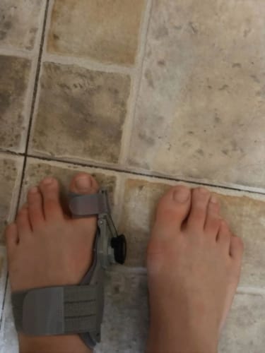 Customer photo review of Bunion corrector | Sameo