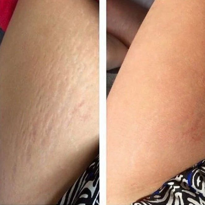 Customer photo review of Crema AntiEstrías🧴🦵 - 200ml EMILY