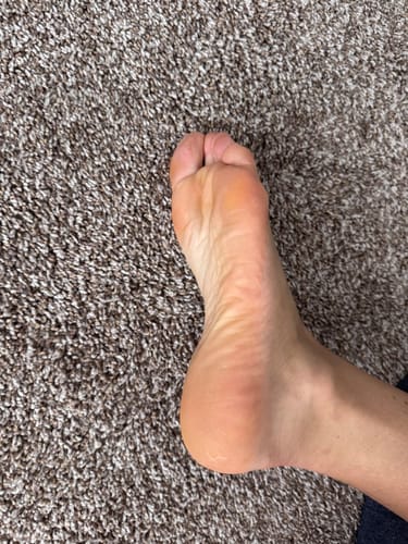 Customer photo review of Dermave™ Foot Callus Remover 2.0