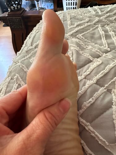 Customer photo review of Dermave™ Foot Callus Remover 2.0
