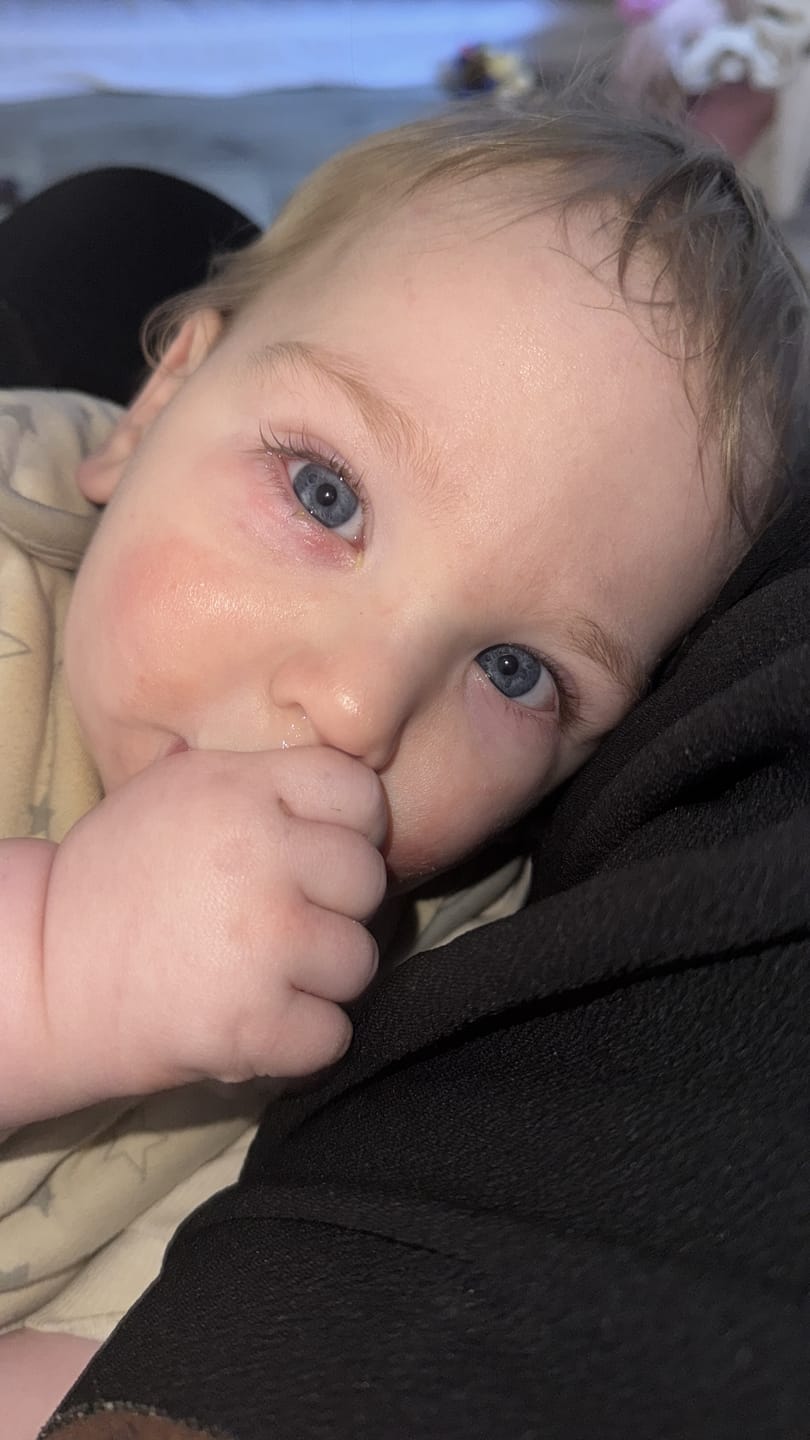 Customer photo review of Bioskin Junior Outbreak Rescue Cream