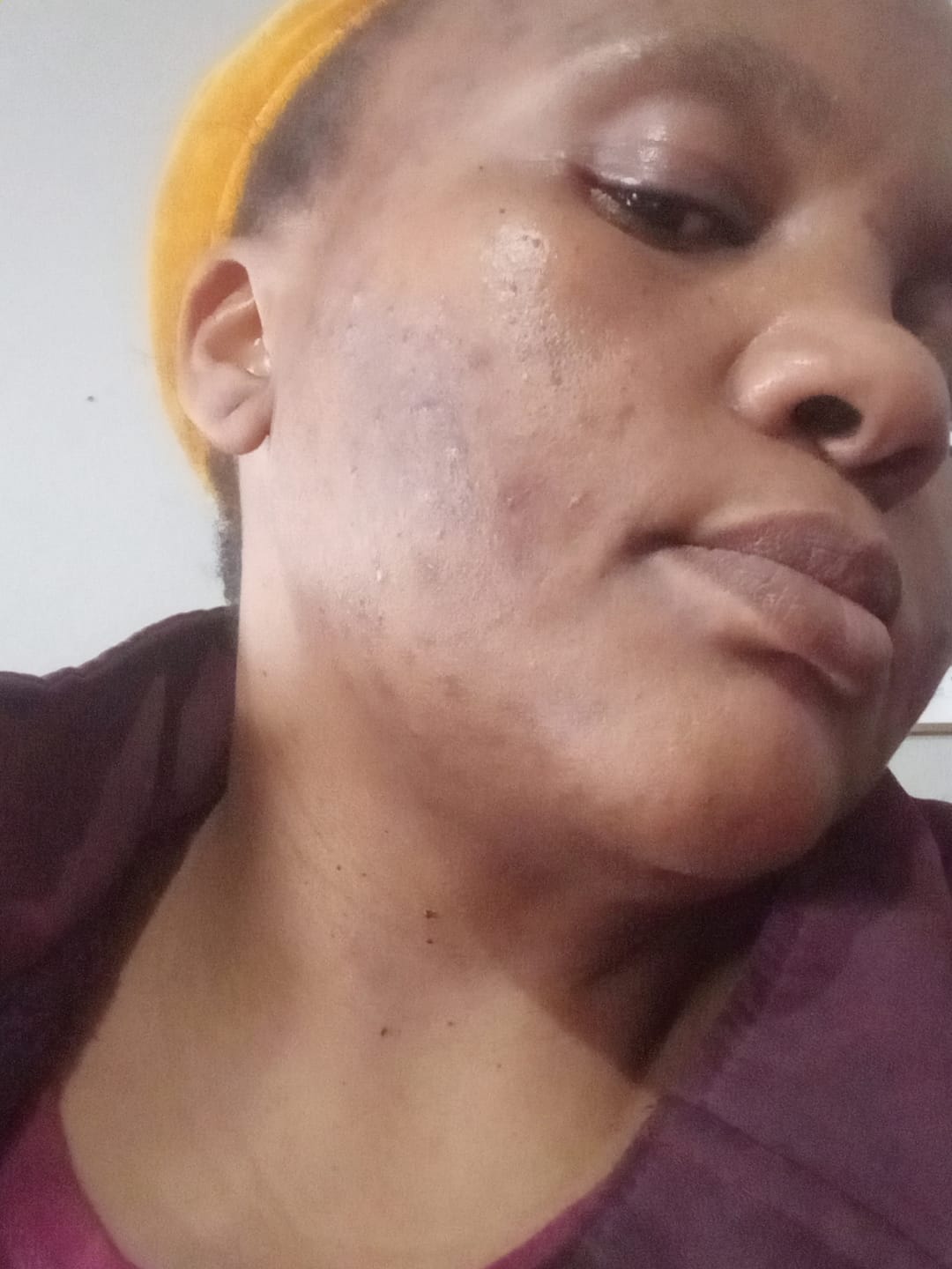 Customer photo review of Gmaeum Clear Complexion Set