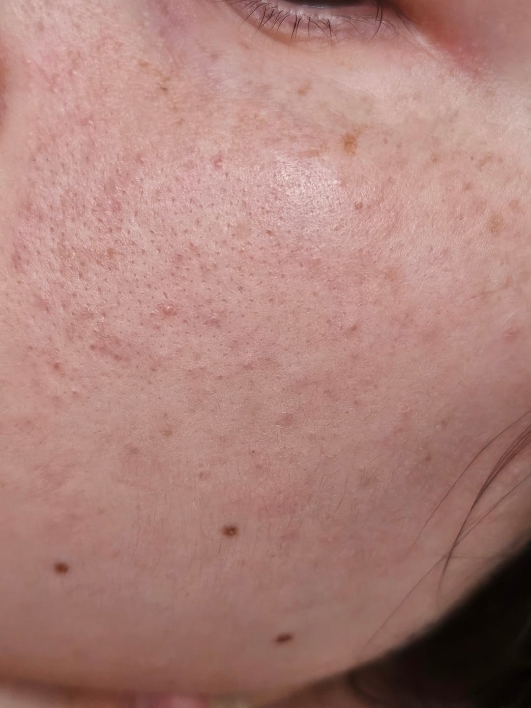 Customer photo review of The Acne Set
