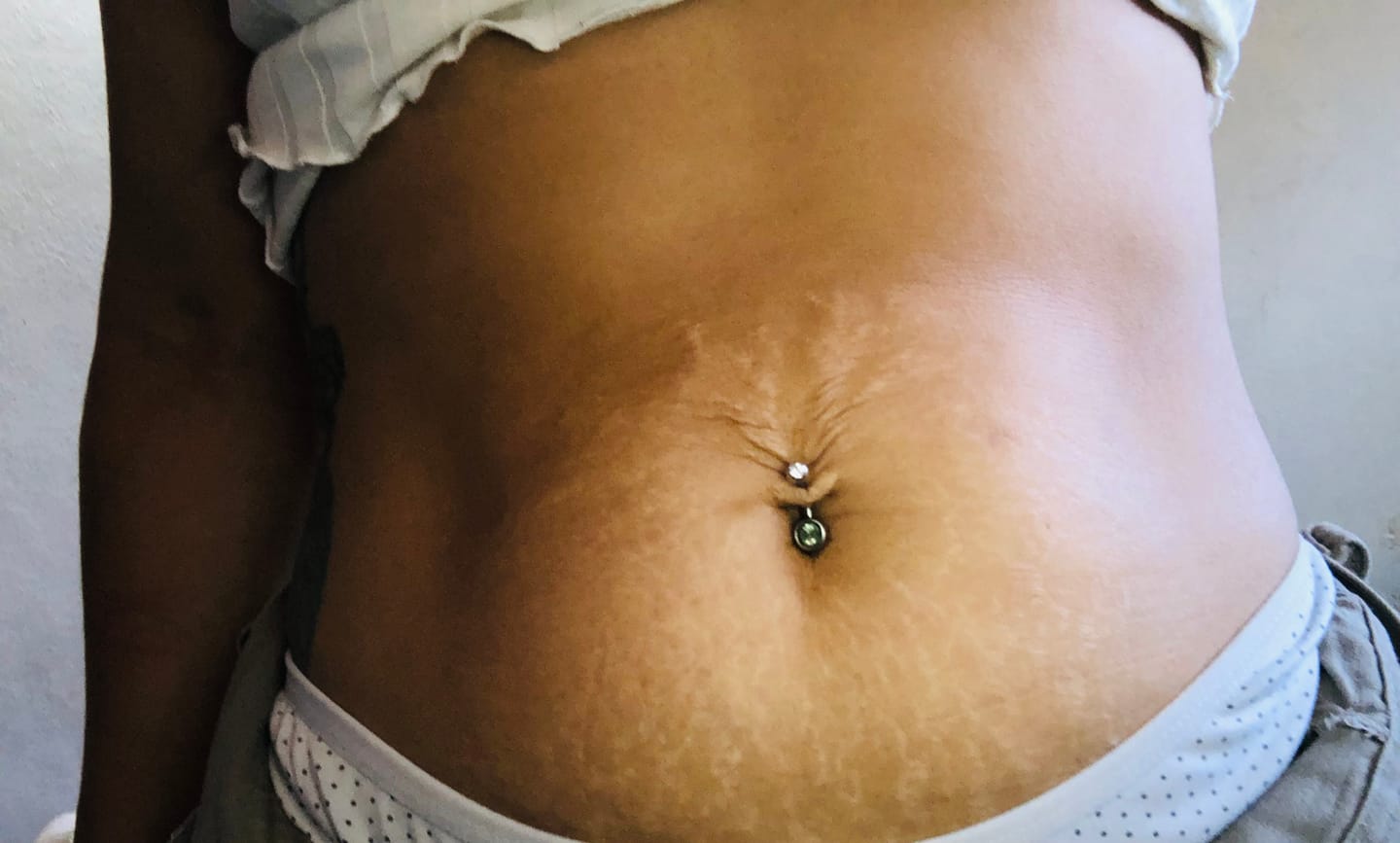 Customer photo review of Crema AntiEstrías🧴🦵 - 200ml EMILY