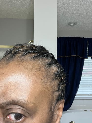 Customer photo review of Rennora Hair Growth Serum