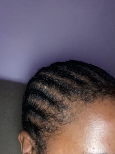 Customer photo review of Minoxi5 Minoxidil SOLUTION, 3 PACK