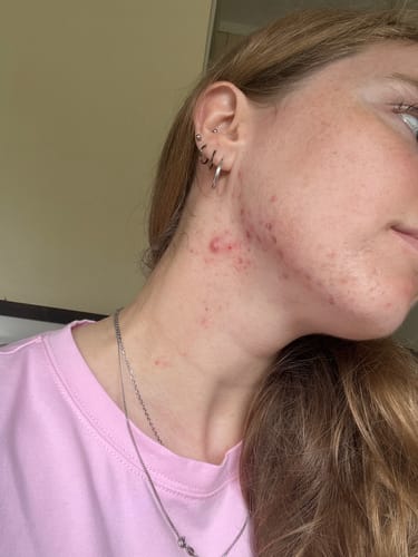Customer photo review of Intermediate Acne Program™