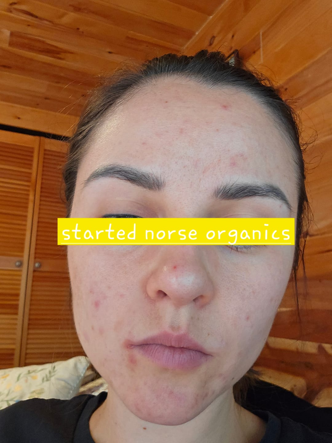 Customer photo review of Kill Acne & Redness Ritual