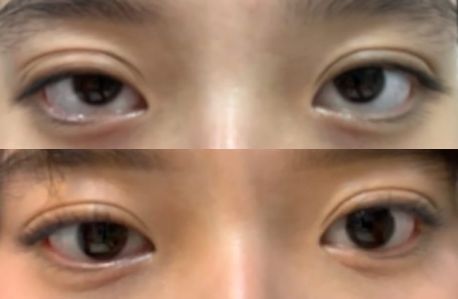 Customer photo review of Optifold EyelidShaping™ Tapes (Standard Pack)