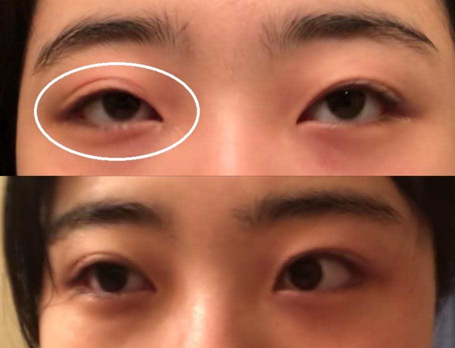 Customer photo review of Optifold EyelidShaping™ Tapes (Standard Pack)