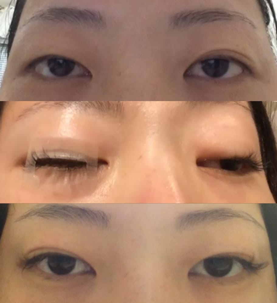 Customer photo review of Optifold EyelidShaping™ Tapes (Standard Pack)