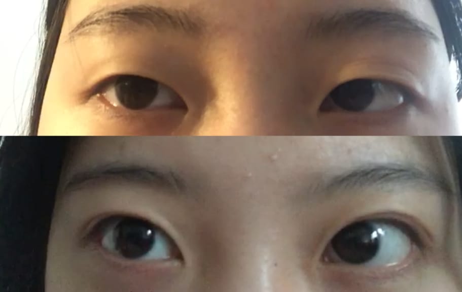 Customer photo review of Optifold EyelidShaping™ Tapes (Standard Pack)