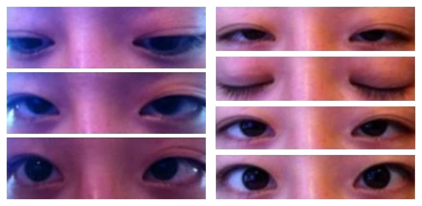 Customer photo review of Optifold EyelidShaping™ Tapes (Standard Pack)