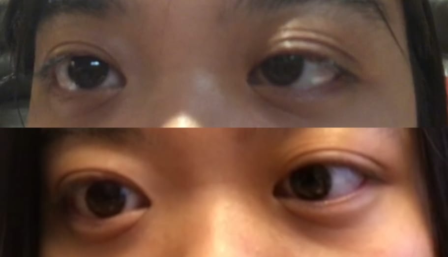 Customer photo review of Optifold EyelidShaping™ Tapes (Standard Pack)