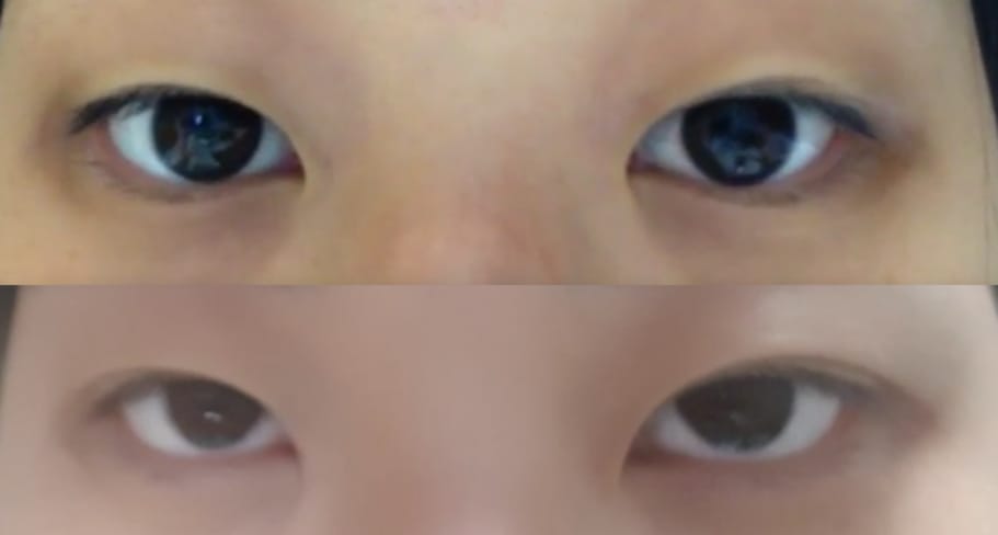 Customer photo review of Optifold EyelidShaping™ Tapes (Standard Pack)