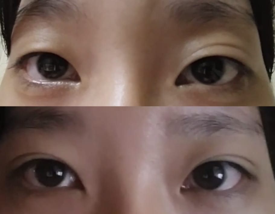 Customer photo review of Optifold EyelidShaping™ Tapes (Standard Pack)