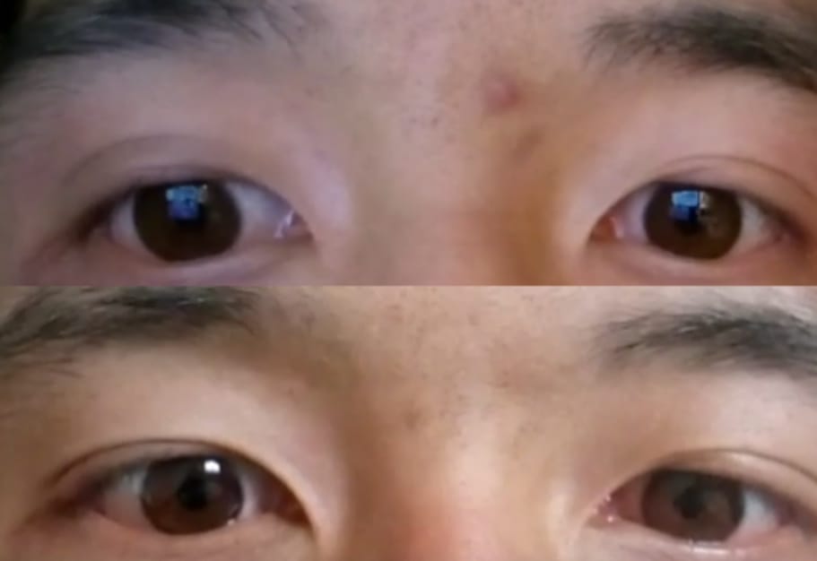 Customer photo review of Optifold EyelidShaping™ Tapes (Standard Pack)