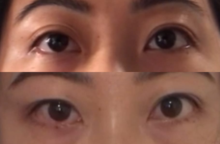 Customer photo review of Optifold EyelidShaping™ Tapes (Standard Pack)