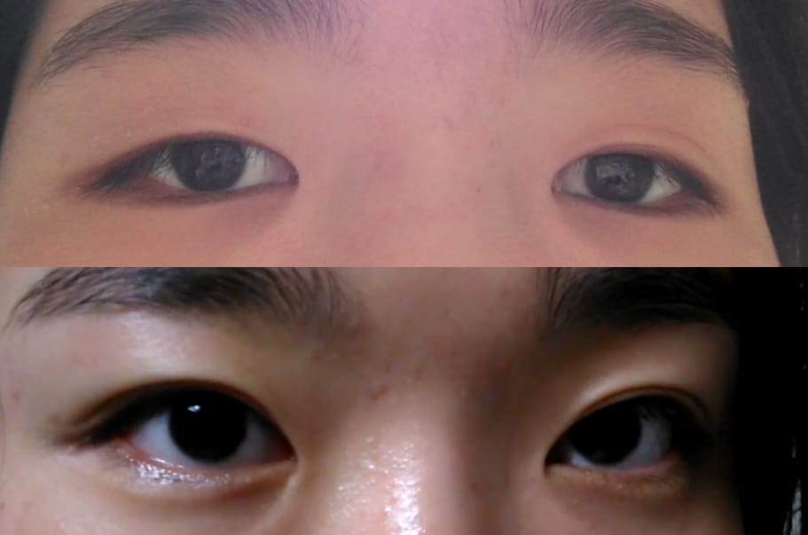 Customer photo review of Optifold EyelidShaping™ Tapes (Standard Pack)