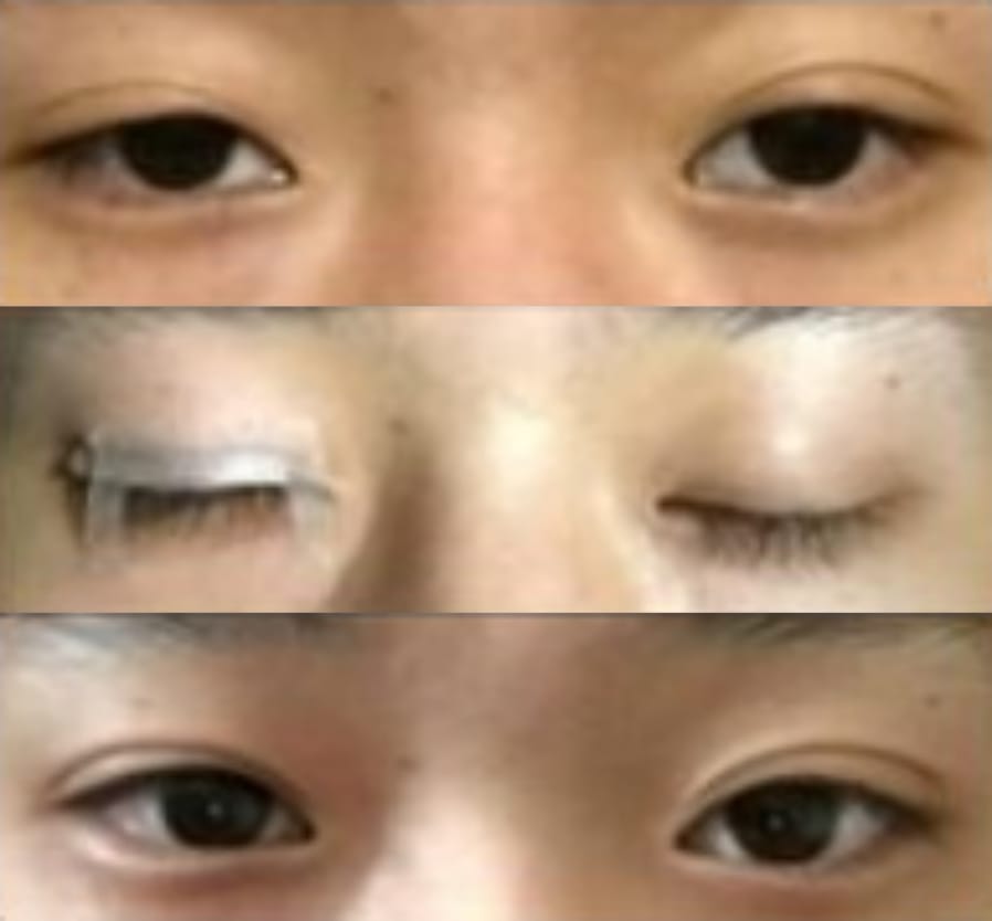 Customer photo review of Optifold EyelidShaping™ Tapes (Standard Pack)