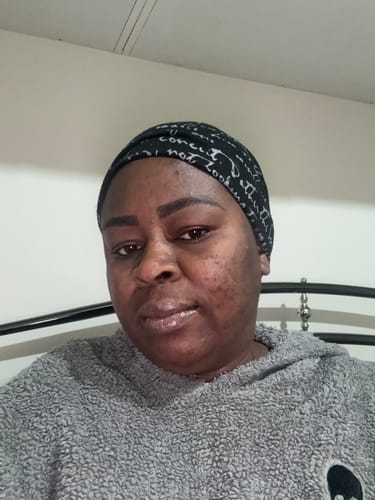Customer photo review of Anti-Acne & Dark Spots African Soap