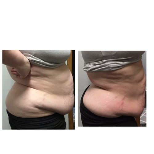 Customer photo review of Adonis 30K Cavitation Machine Pro 9 in 1