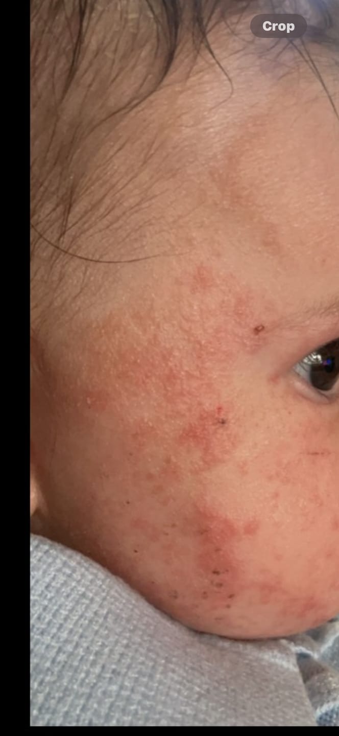 Customer photo review of Bioskin Junior Outbreak Rescue Cream
