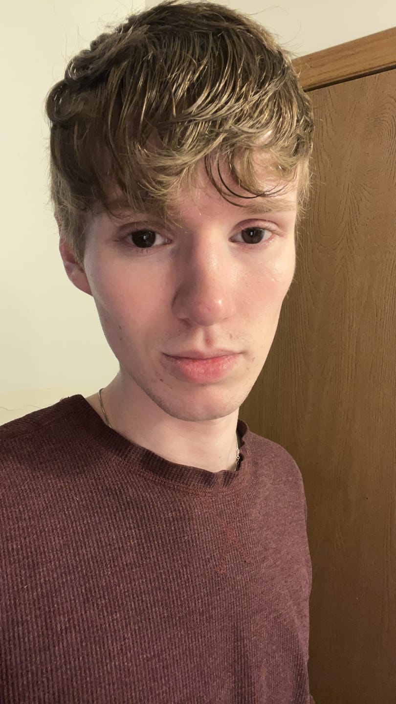 Customer photo review of Eyeling Custom Lens (6 months)