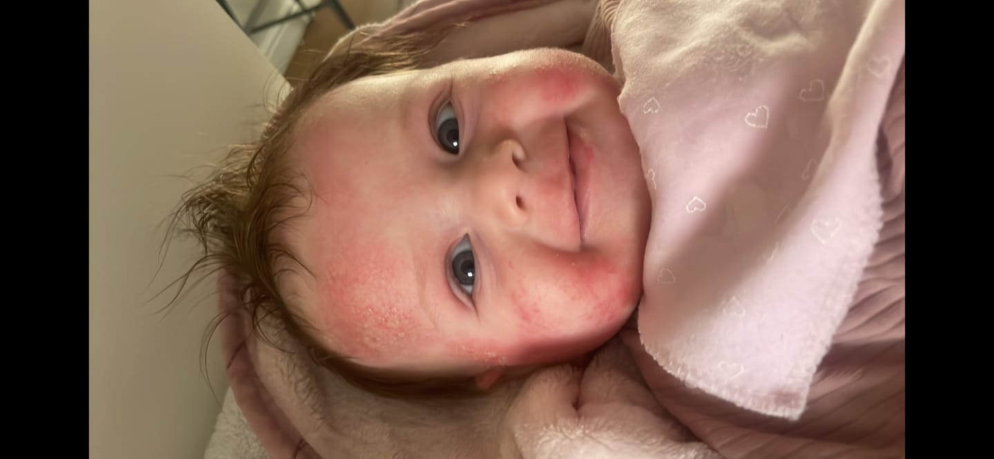 Customer photo review of Bioskin Junior Outbreak Rescue Cream