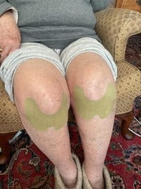 Customer photo review of ReliveX™ Knie Pleisters