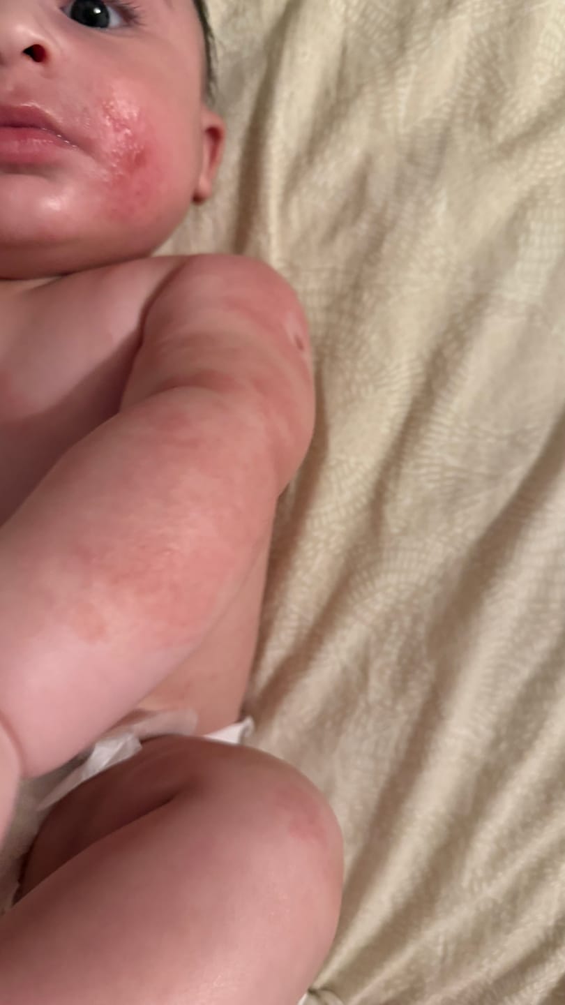 Customer photo review of Bioskin Junior Value Bundle