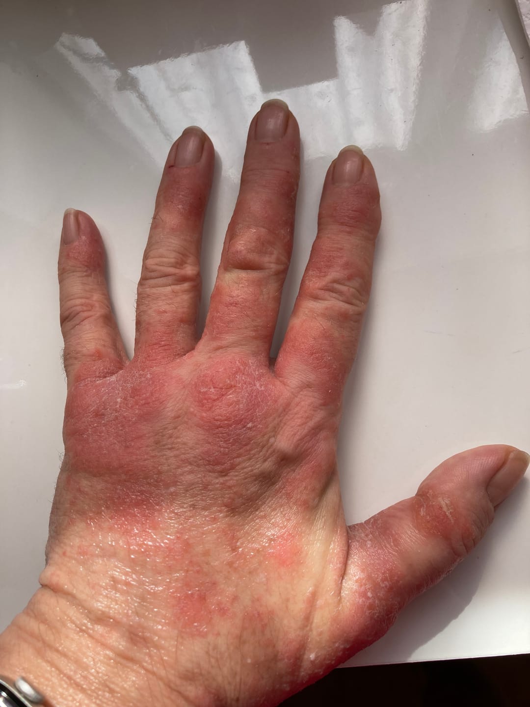 Customer photo review of OMNi-BiOTiC SKiN® Intensiv-Pflegesalbe