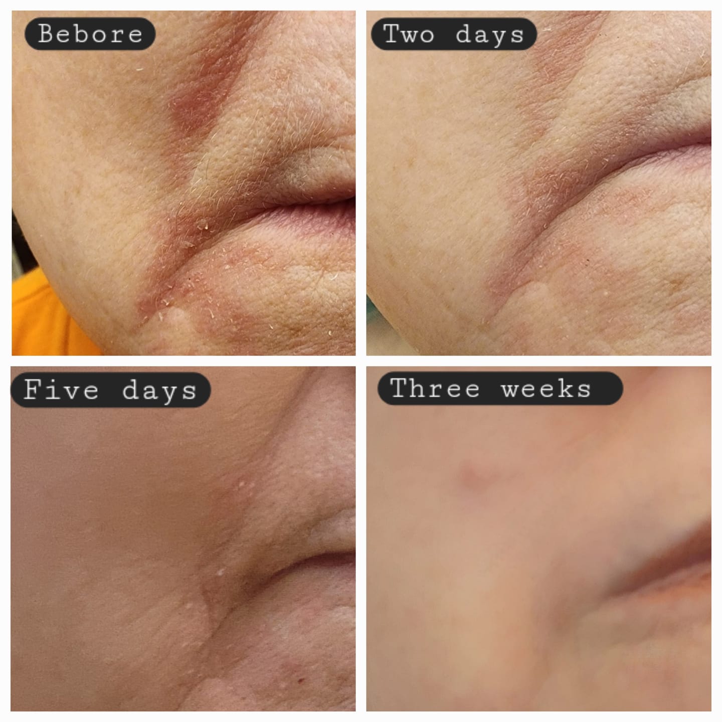 Customer photo review of Hypochlorous Acid Spray for Skin & Face | Cleansing Topical Spray