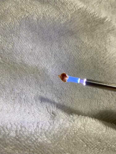 Customer photo review of ClearEar™ Earwax Removal Kit