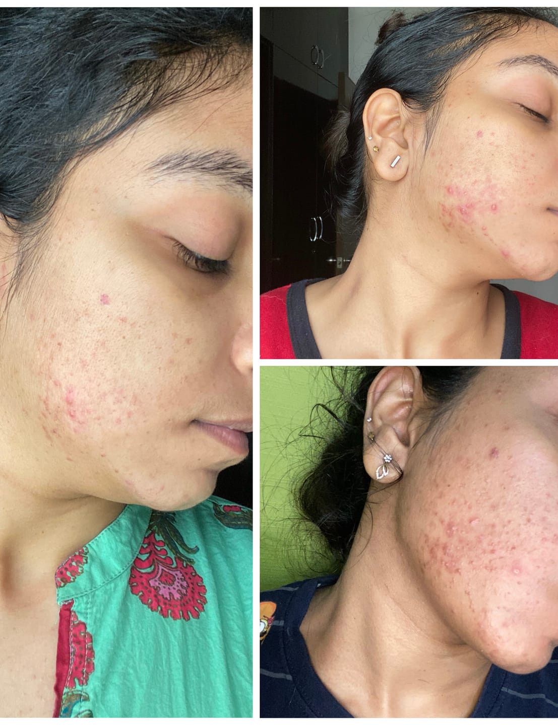 Customer photo review of Kill Acne & Redness Ritual