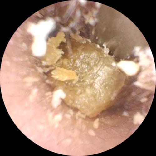 Customer photo review of ClearEar™ Earwax Removal Kit