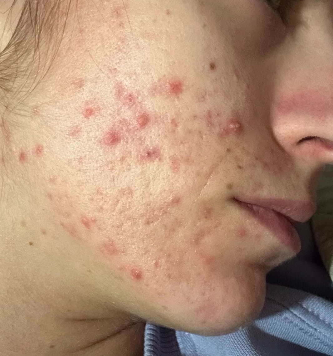 Customer photo review of MIRACLE H -  ÁCIDO HIPOCLOROSO - TÓNICO ANTIBACTERIANO Y ANTIINFLAMATORIO